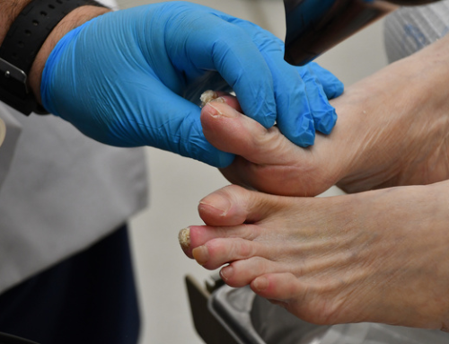 How to Break Up Scar Tissue After Bunion Surgery
