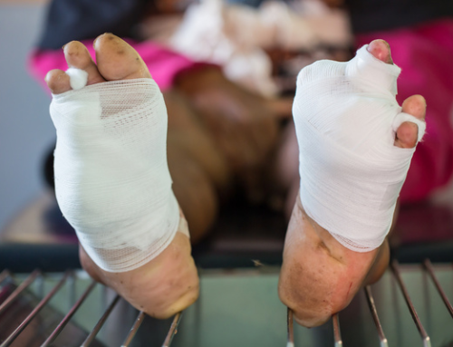 How To Care for Diabetic Foot Wound