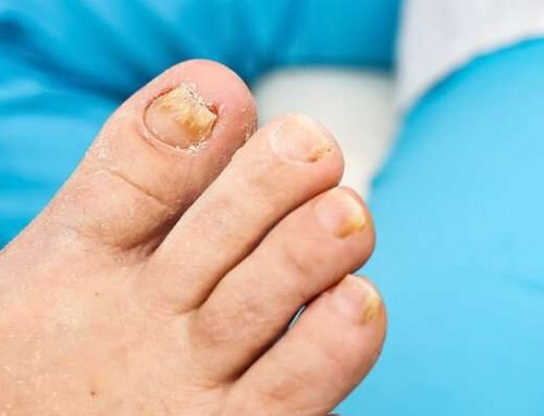 Best Over-the-Counter Toenail Fungus Treatments: What Actually Works