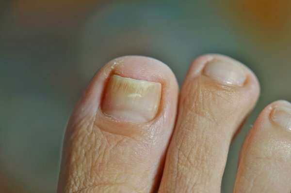 Toenail Fungus
