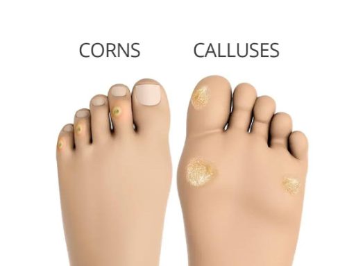 How To Treat Corns And Calluses In 7 Ways