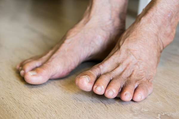 Diabetic Wound