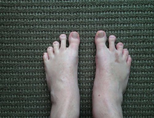 Early Warning Signs of Morton’s Neuroma: What You Need to Know