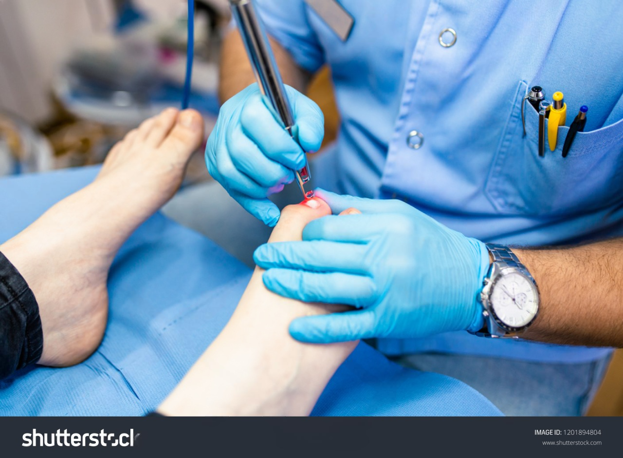 Doctor completing Treatment for Toenail Fungus