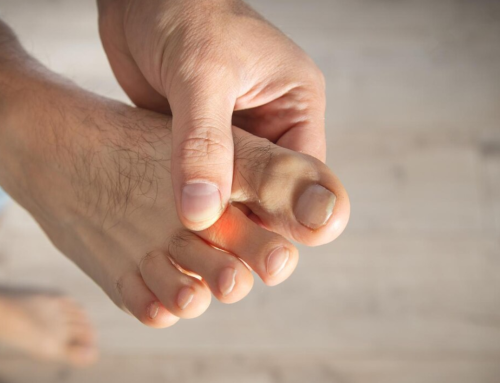 Understanding Athlete’s Foot Between the Toes: Causes, Symptoms, and Treatments
