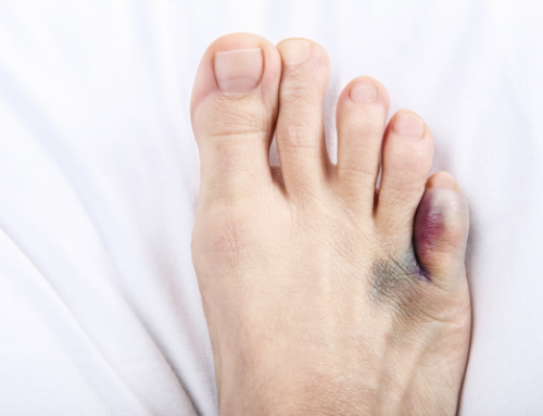 Broken or Sprained Toe: Pinky Toe Injury Guide