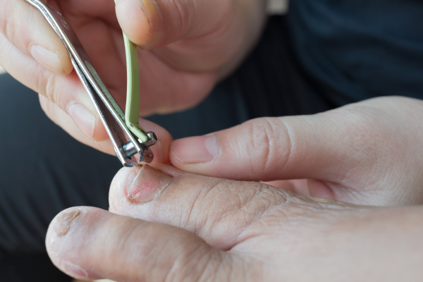 Nail trimming of infected toenail during professional foot care for toenail fungus