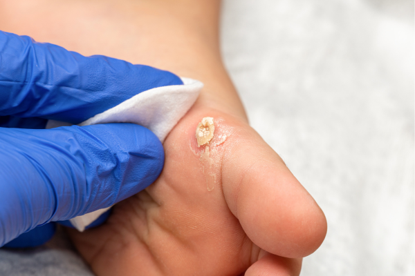 A podiatrist wearing blue gloves performs a professional foot corn debridement, carefully cleaning the thickened hyperkeratotic lesion on a patient's foot in a clinical setting.