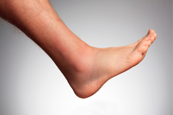 A clean side-profile view of a healthy, smooth adult foot showing no signs of painful corns or skin lesions following a successful podiatric evaluation.