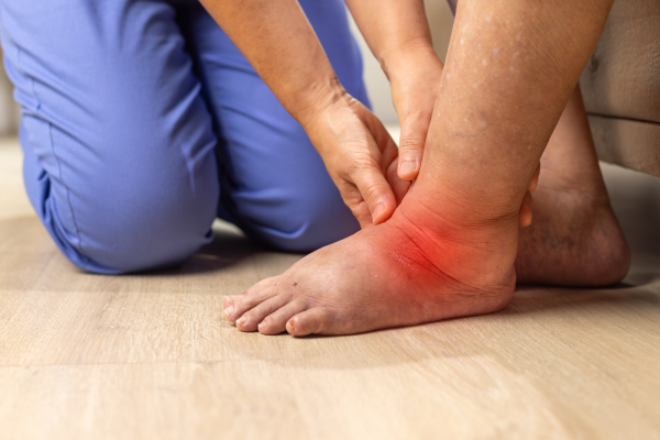 Close-up of a patient's swollen and inflamed ankle with a red highlighted area indicating acute gout flare pain, being assessed by a podiatrist at Foot & Ankle Centers of New Jersey